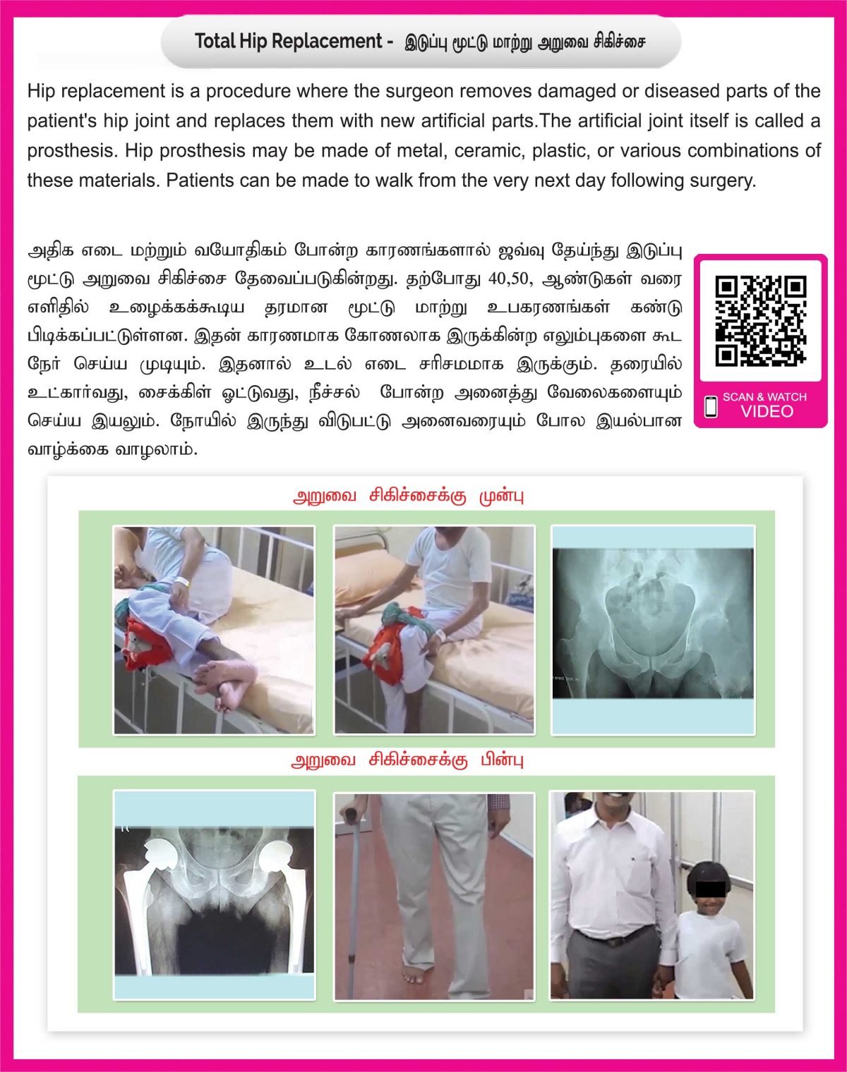 Total Hip Replacement